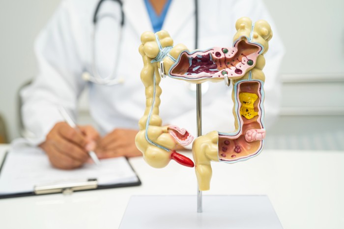 Medical model of human large intestine with doctor writing notes in background.